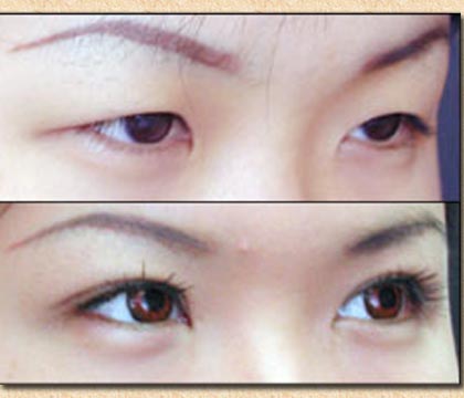Eye Surgery For Asian 23